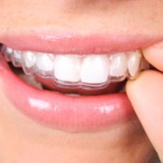 Smile with confidence – Invisalign