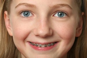 Are braces the best option for teenagers?