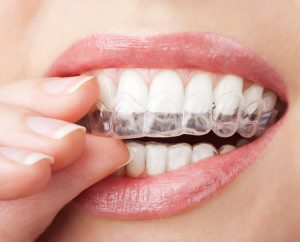 Invisalign Vs Braces