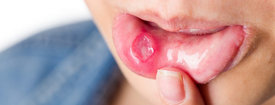 Painful mouth ulcer