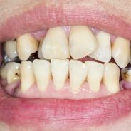 Study Finds Bad Teeth Can Ruin Your Career