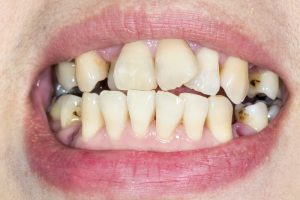 Bad teeth at job interviews