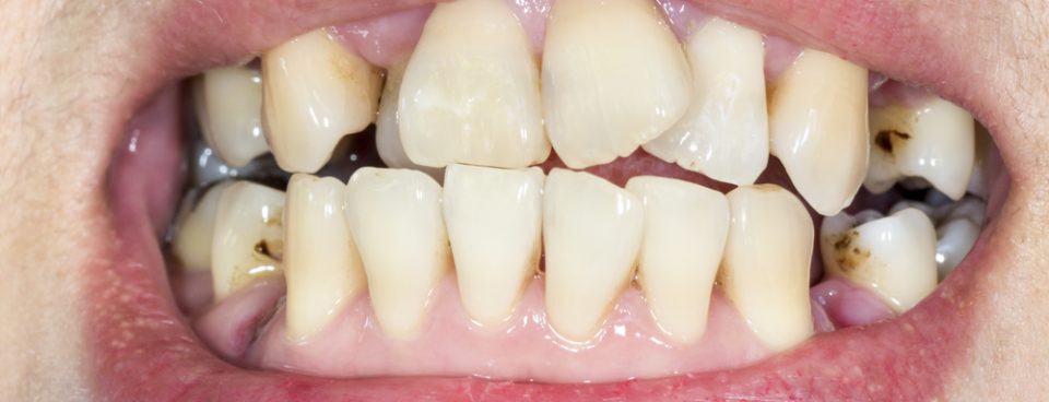 Bad teeth at job interviews
