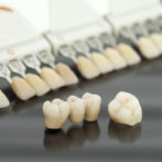 Veneers