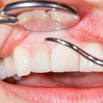 Diabetes: Gum Mouth And Teeth Problems To Watch