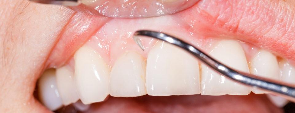 Gum mouth and teeth problems