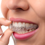 Is Invisalign Teeth Straightening The Answer To Your Dream Smile?