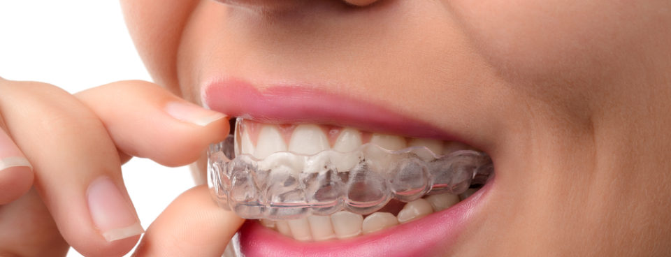 Invisalign teeth straightening
