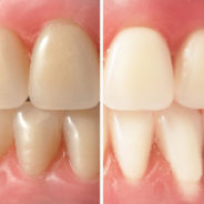 The Disturbing Rise of Teeth Whitening in Brisbane