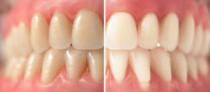 Teeth whitening Brisbane