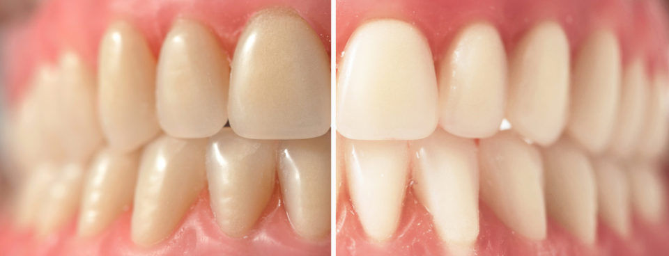 Teeth whitening Brisbane