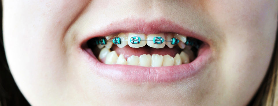 My Child Is Getting Braces