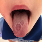 Help! Do I have Geographic Tongue?