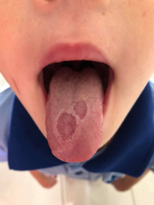 Help! What is Geographic Tongue and Do I Have it?