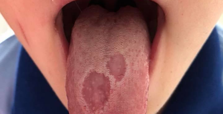 Geographic Tongue