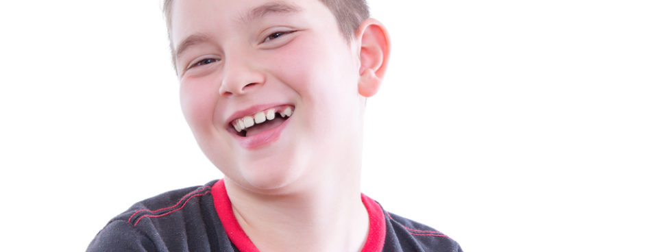 Teeth Braces