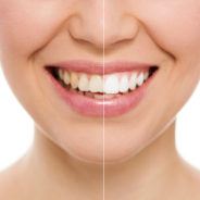 Can My Teeth Be Whitened? Teeth Whitening Or Cosmetic Veneers