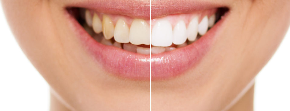 Teeth Whitening Brisbane