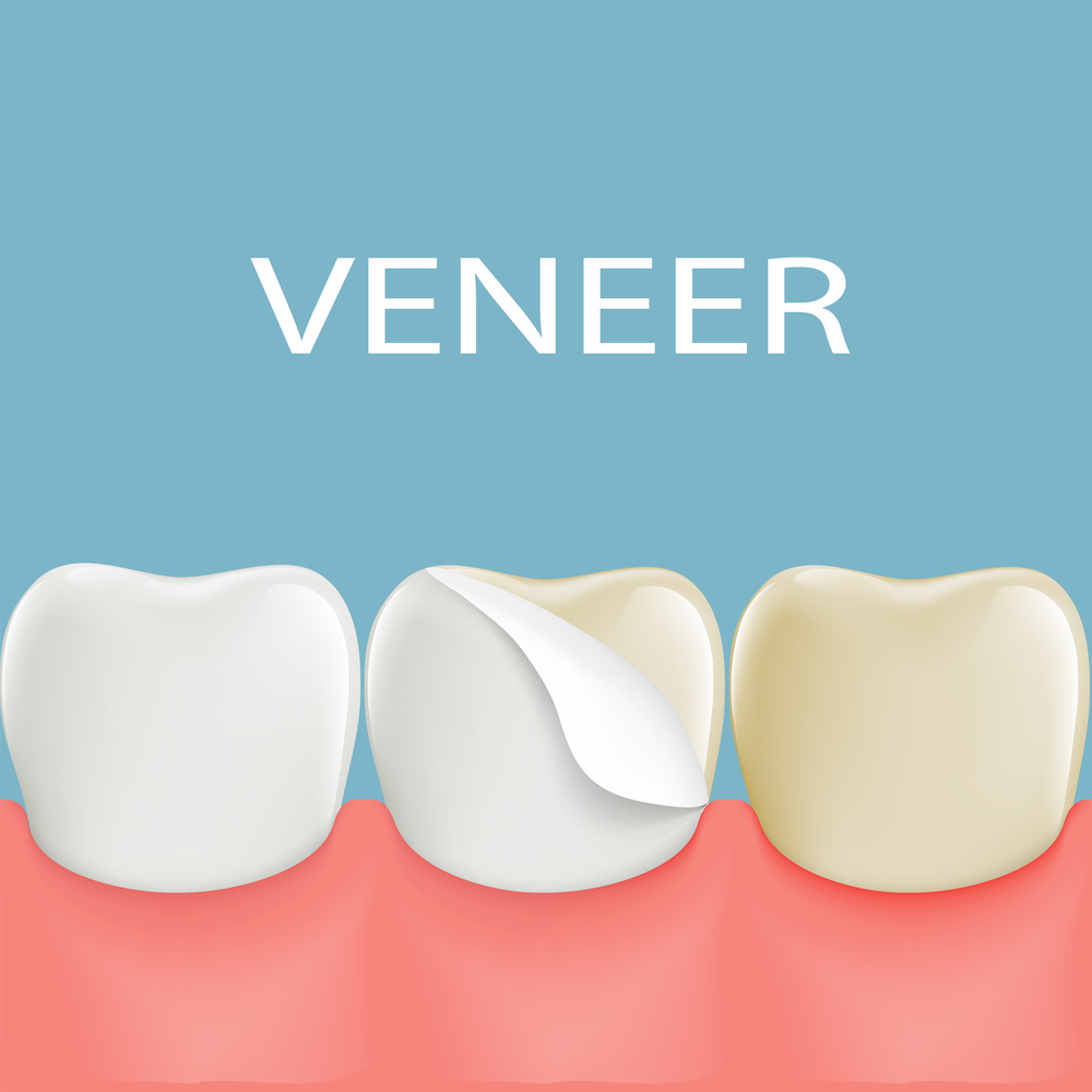 Dental veneers