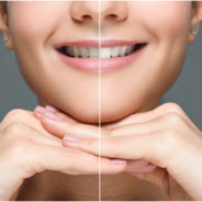 What to Expect During In-Chair Teeth Whitening: Brisbane Dentist Explains