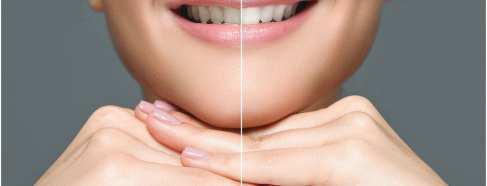 teeth whitening Brisbane