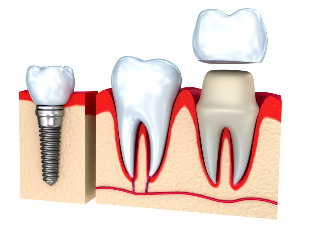  Looking for info on a tooth cap or crown? Here’s what you need to know before you invest in a gold tooth cap!